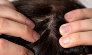 Thu hồi lô dầu gội trị chấy kém chất lượng