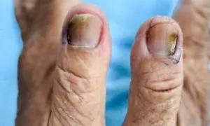 50 năm bị nấm móng 50 năm bị nấm móng
