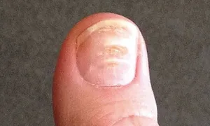 7 bất thường ở móng tay cảnh báo bệnh nguy hiểm